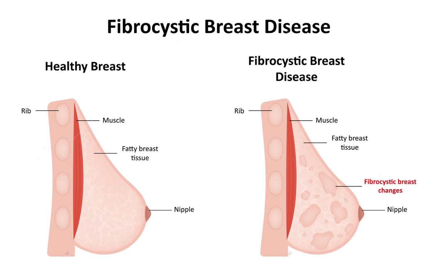 Coffee and Breast Lumps: Is There a Connection? 1 A medical illustration comparing a healthy breast to one with fibrocystic changes, providing context for the discussion on can coffee cause breast lumps